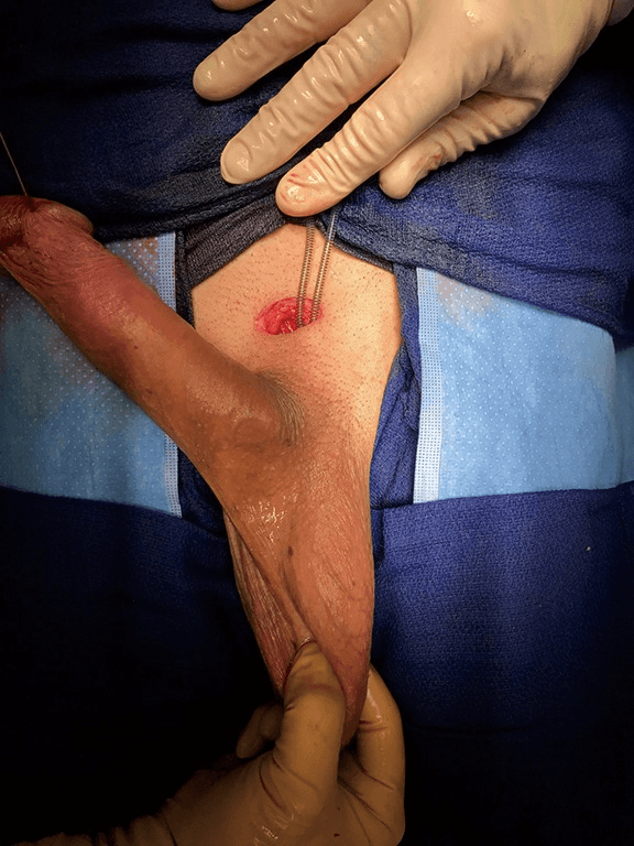 Fotografia clinica del sito di incisione sopra il pube.